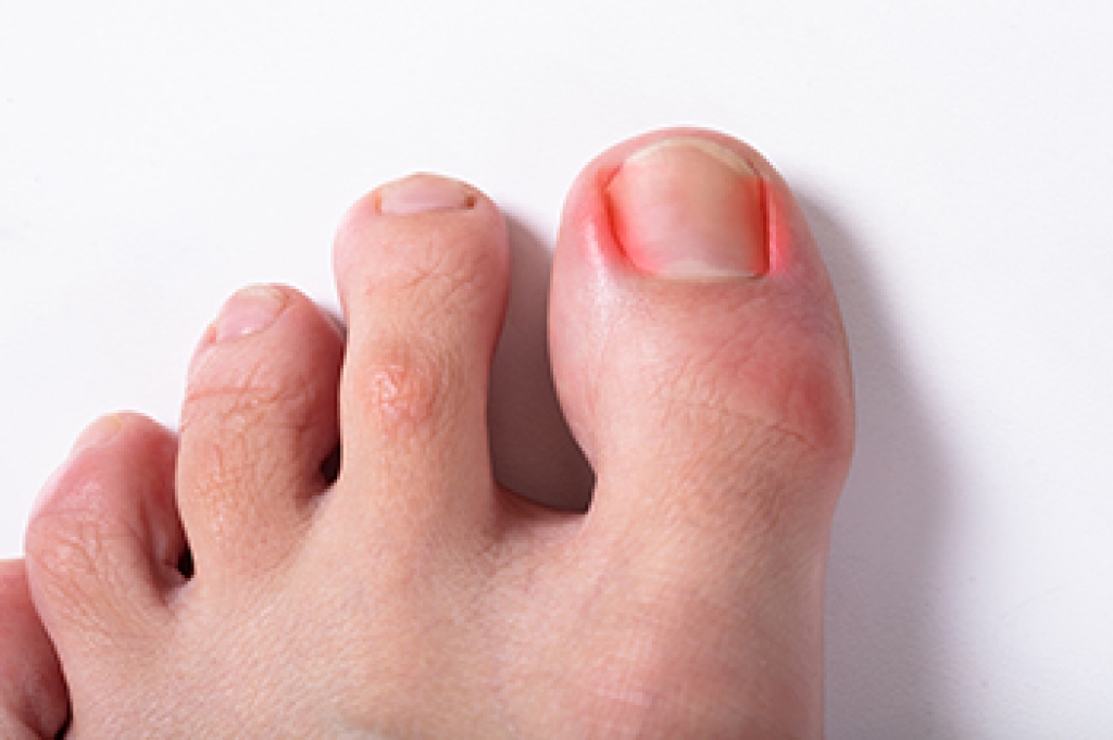Ingrown Toenails and Podiatry Care