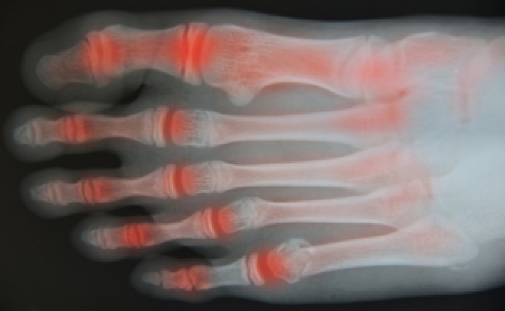 Osteoarthritis and Its Impact on Foot Health