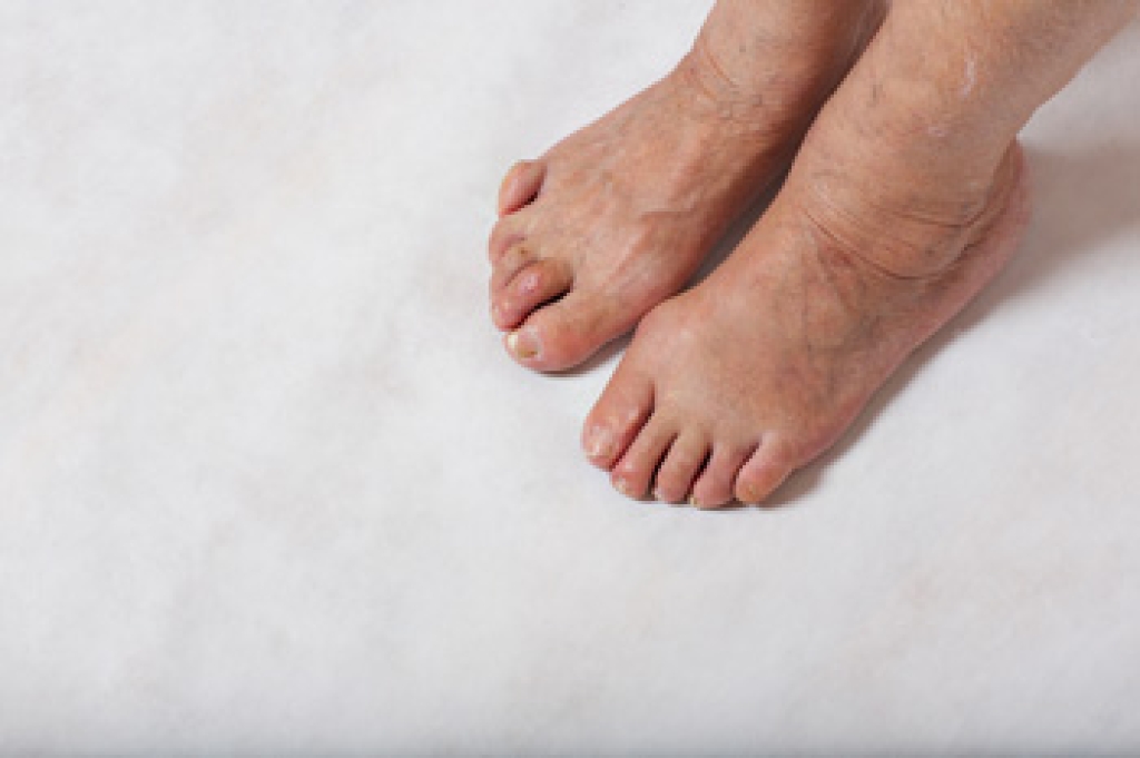 When to Seek Treatment for Hammertoe