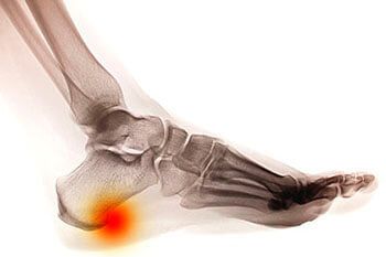 Heel Spurs Treatment Foot Doctor Windsor Ontario N8S 1X1 Canada