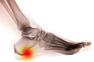 Heel Spur Information