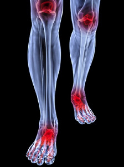 How Does Arthritis Affect the Feet