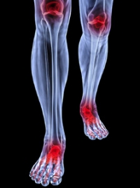 How Does Arthritis Affect the Feet?