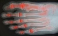 Arthritis in the Big Toe