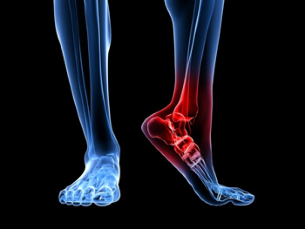Heel spur ankle pain hotsell
