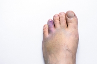 When to See a Doctor for a Broken Toe