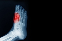 Causes of Sesamoid Problems