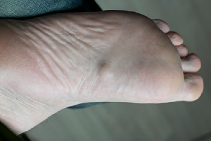 Foot orthotic for plantar fibroma discount