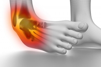 Risk Factors for Spraining an Ankle